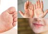La enfermedad del verano que asusta a los padres: todo lo que debes saber sobre la infección mano-pie-boca en niños